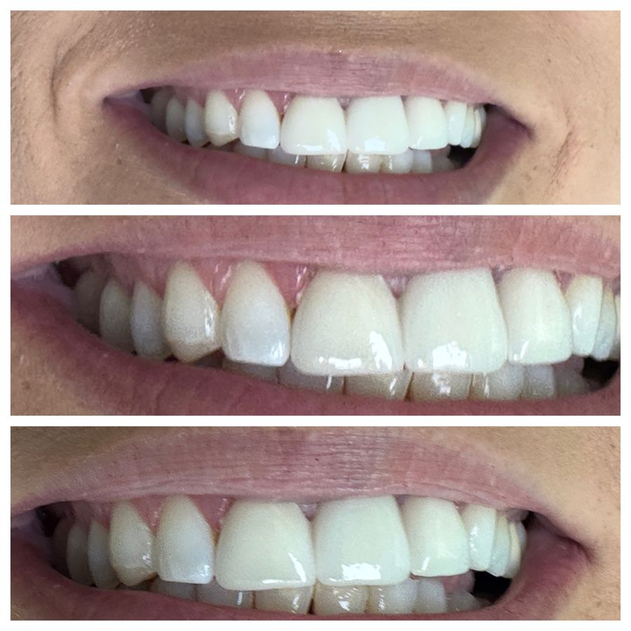 Before-and-after dental result, case 2