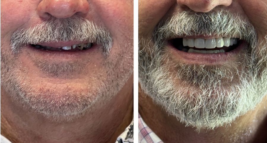 Before-and-after dental result, case 6