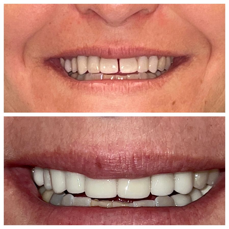 Before-and-after dental result, case 5