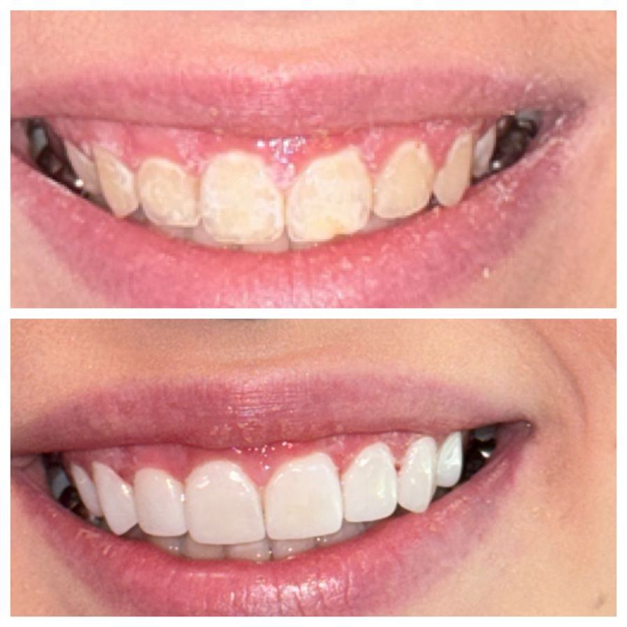 Before-and-after dental result, case 12