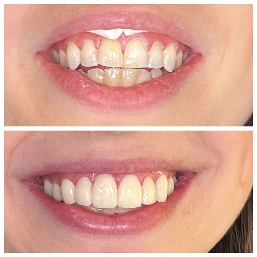 Before-and-after dental result, case 7