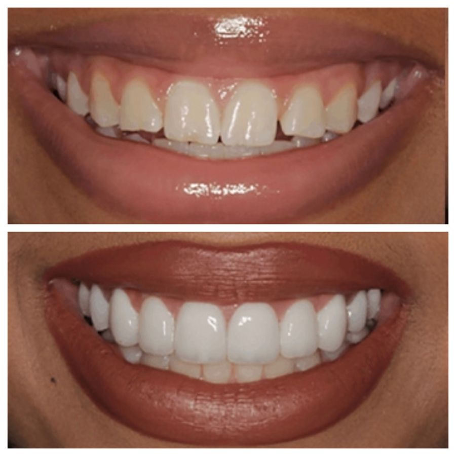 Before-and-after dental result, case 1