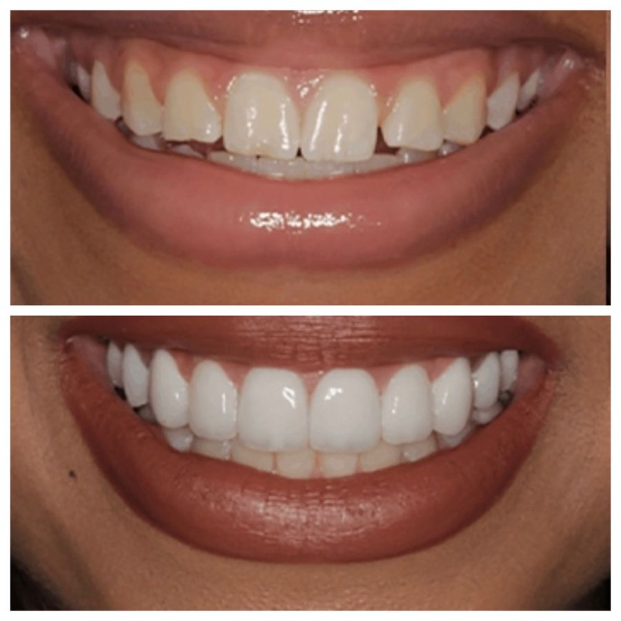 Before-and-after dental result, case 3