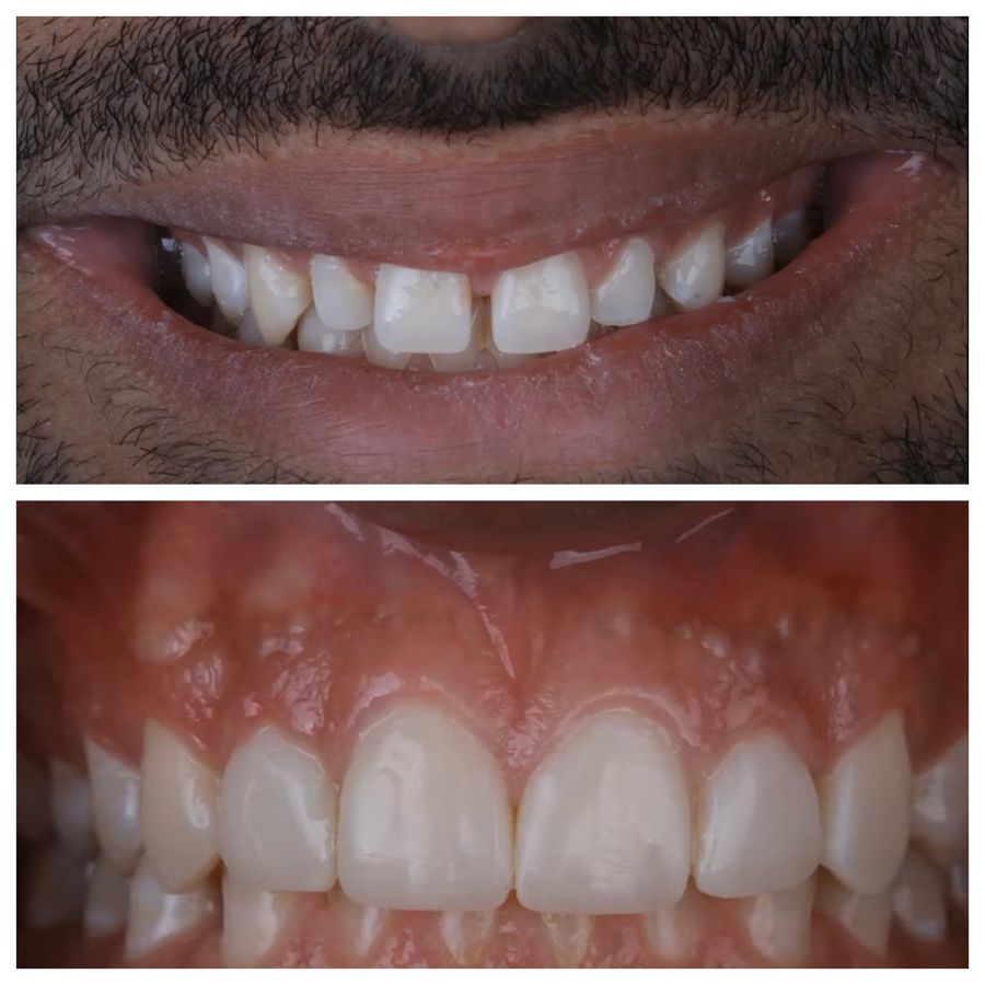 Before-and-after dental result, case 4