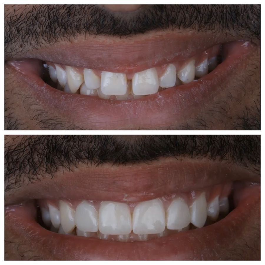 Before-and-after dental result, case 11